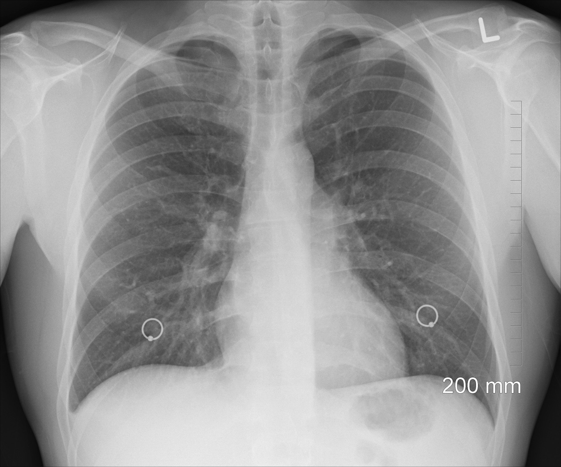 Example Of Rapid Syndromic Testing Respiratory Infections Case