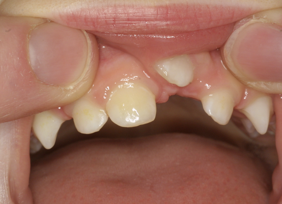 Trauma To Primary Teeth Case Example